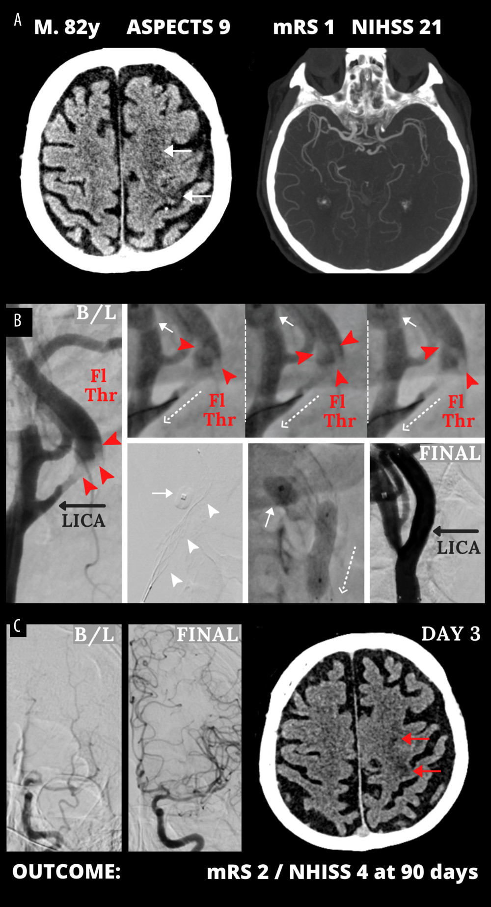 Emergency mechanical reperfusion in acute carotid artery origin ischemic stroke. (A), (left panel) – mild vascular changes (white arrows) seen on admission cerebral computed tomography Alberta Stroke Program Early Computed Tomography Score (ASPECTS) 9 in a patient who was emergency-transferred to a cardioangiology-based Thrombectomy-Capable Stroke Center from external Neurology; (right panel) – diminished flow to the left hemisphere on computed tomography angiography (compare left vs right). (B) Catheter angiography – left internal carotid artery (LICA) near-occlusion with a floating thrombus (Fl Thr, red arrowheads) and next stages of emergency mechanical reperfusion (from left to right, upper and lower panels): transient flow reversal (dotted arrows; enhanced by active aspirations at the procedure critical steps) – proximal cerebral protection device – Mo.Ma (Medtronic, Tolochenaz, Switzerland), external carotid artery balloon (white arrow). Following thrombectomy (carotid-dedicated adjustable-diameter stentriever – TigerTrieverXL (Rapid Medical, Yokneam, Israel), the culprit lesion was sequestrated (white arrowheads), using a micronet-covered stent – C-Guard (InspireMD, Tel Aviv, Israel) with post-dilatation embedding. (C), (left panel) – effective lumen reconstruction resulted in normalized left hemispheric cerebral blood supply symptoms regressed, (right panel) – discharge cerebral computed tomography showed a minor cerebral infarct (red arrows). B/L indicates baseline, (mag) = magnified image. Figure was created with the use of Canva (Perth, Australia).