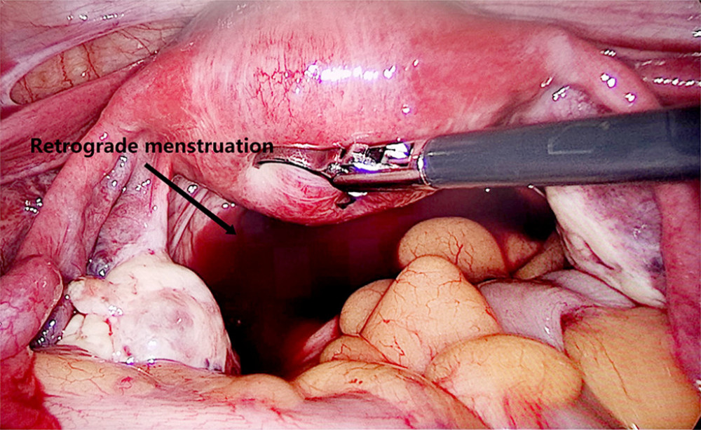 Retrograde menstrual blood revealed during laparoscopic surgery (the arrow means retrograde menstruation). Image software: Adobe Photoshop, CS6, Adobe Systems.