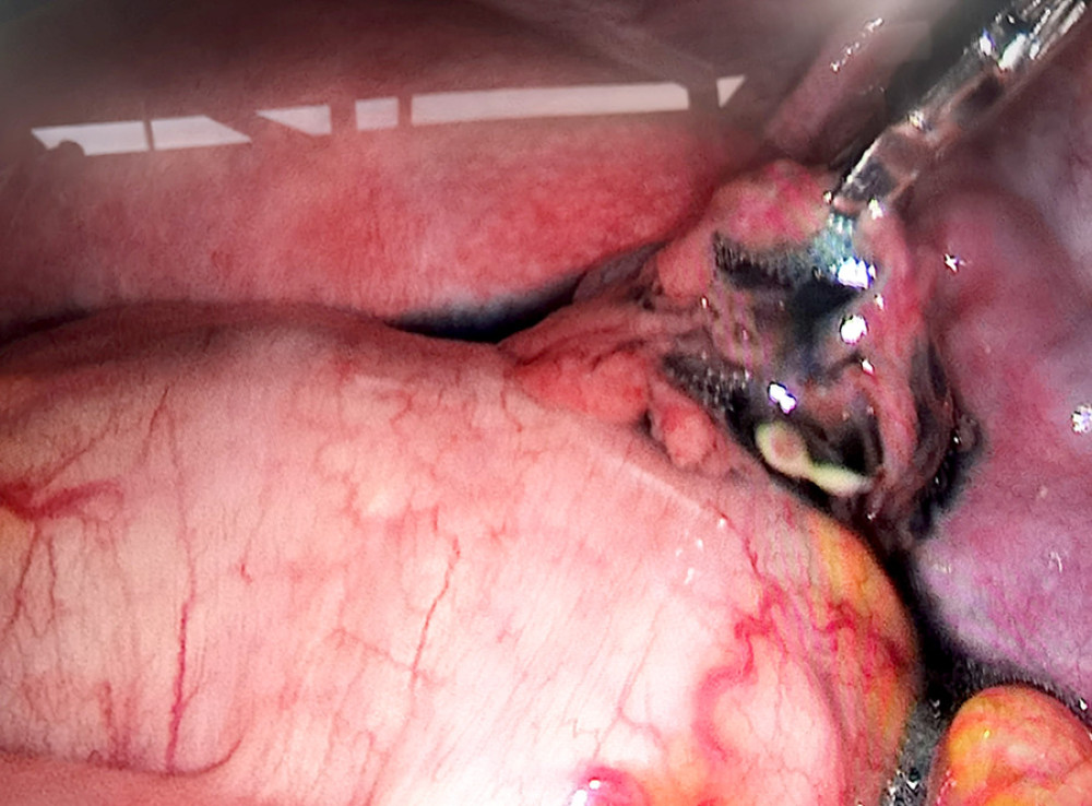 Right patent fallopian tube revealed under laparoscopy (outflow of methylene blue solution). Image software: Adobe Photoshop, CS6, Adobe Systems.