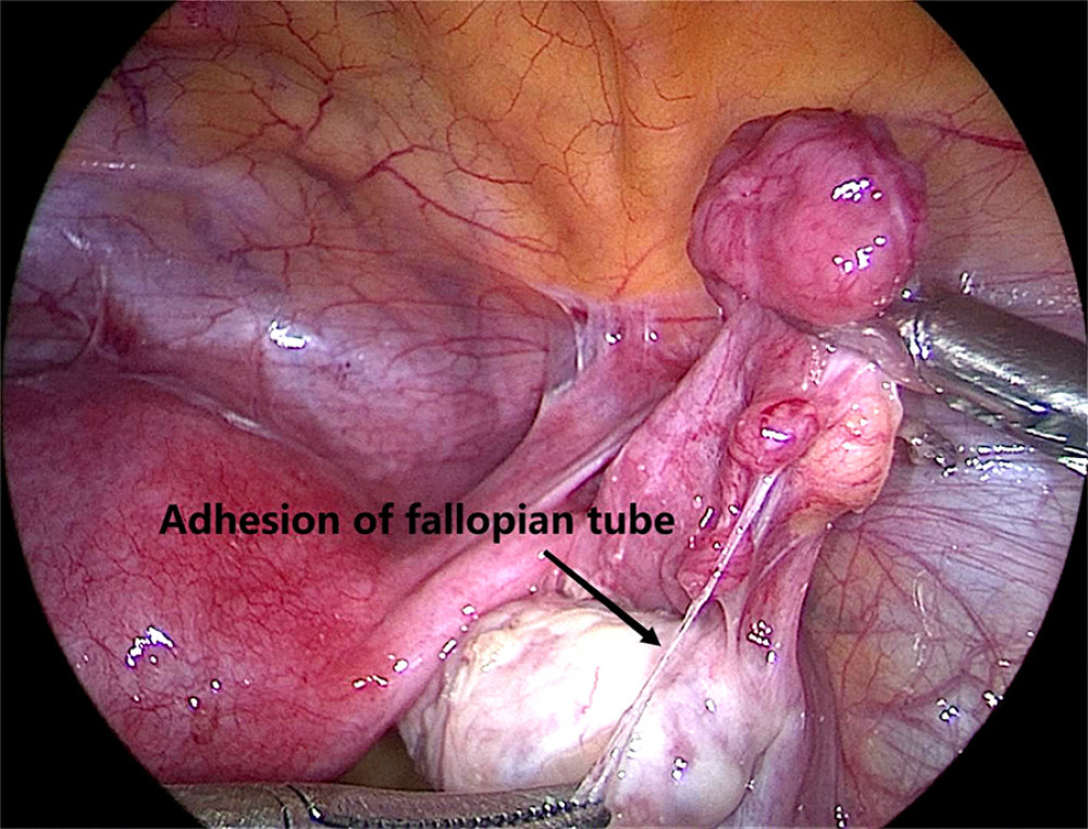 Adhesion of fallopian tube revealed during laparoscopy (the arrow means adhesion of fallopian tube). Image software: Adobe Photoshop, CS6, Adobe Systems.