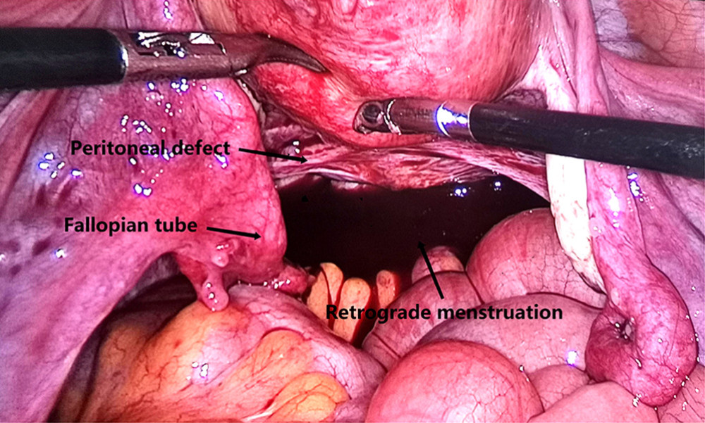 Fallopian tubes immersed in bloody peritoneal fluid (the arrows mean peritoneal defect, fallopian tube and retrograde menstruation respectively). Image software: Adobe Photoshop, CS6, Adobe Systems.