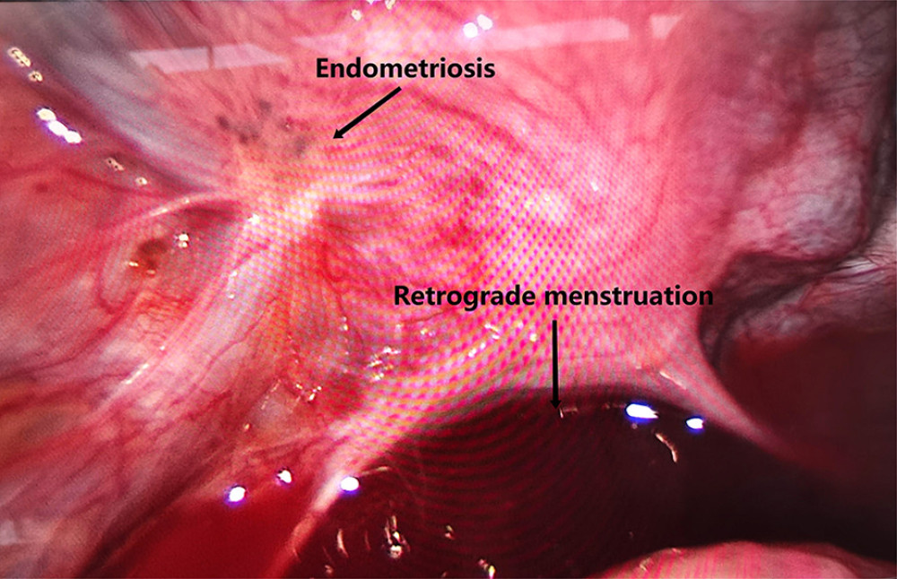 Peritoneal endometriosis before laparoscopic electrocautery (the arrows mean endometriosis lesion and retrograde menstruation respectively). Image software: Adobe Photoshop, CS6, Adobe Systems.