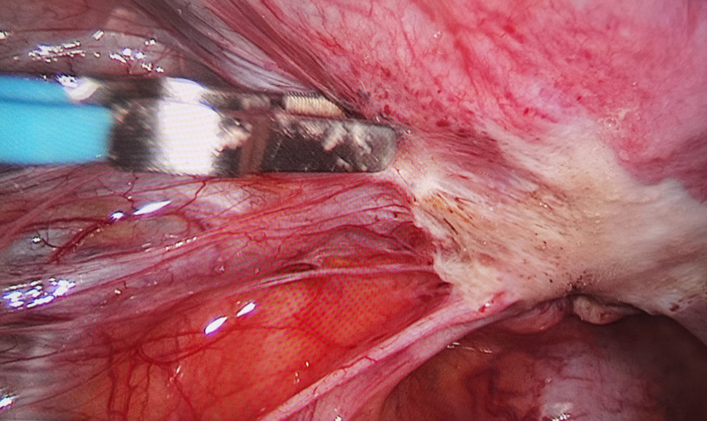 Peritoneal endometriosis after laparoscopic electrocautery. Image software: Adobe Photoshop, CS6, Adobe Systems.