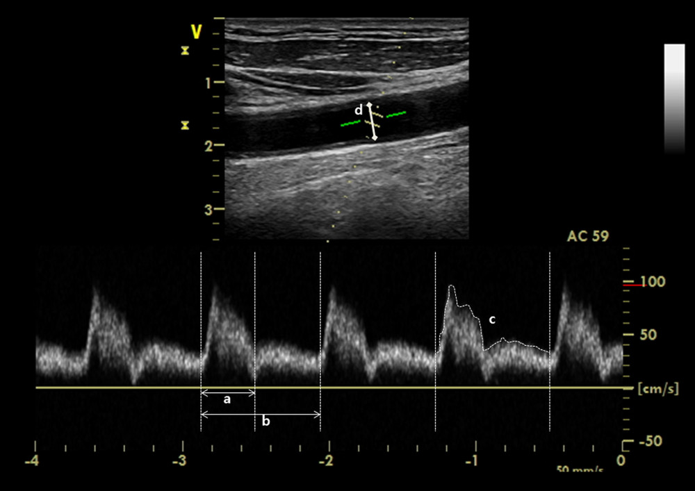 Corrected carotid flow time was calculated by the measurement of interval between the start of systolic upstroke and the dicrotic notch of the spectral Doppler waveform: a) systole time; b) cycle time. Carotid blood flow was calculated by the measurement of velocity time integral tracing of the c) spectral Doppler signal and d) carotid diameter.