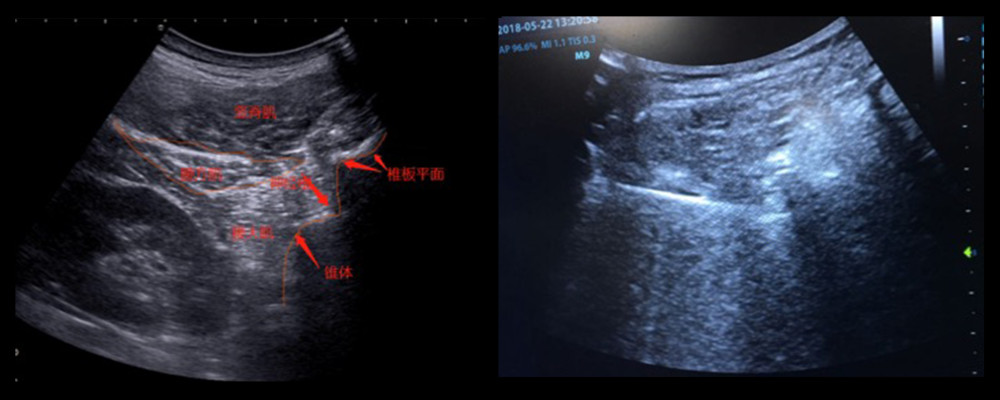 For puncture, the needle tip reaches the intervertebral foramen just before and below the facet joint.