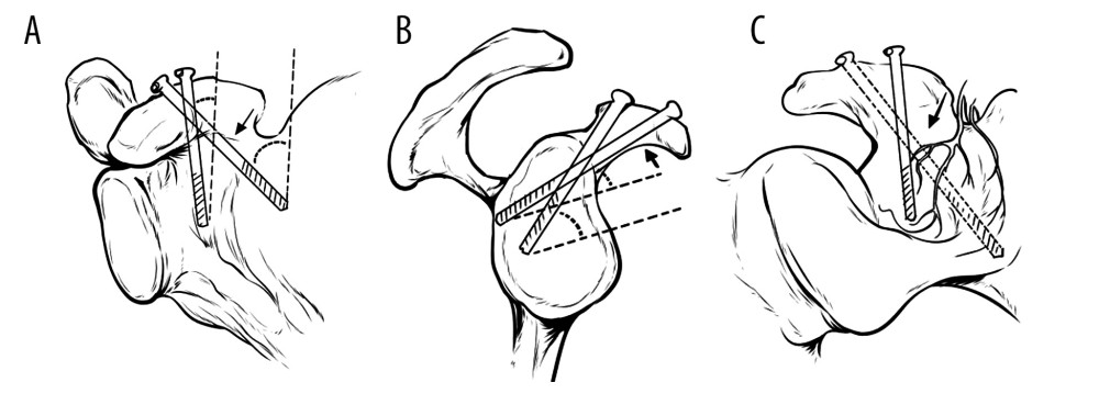 The direction of the screw for coracoid process fracture. The direction (↖) has increased coronal plane with anterior posterior view (A) and decreased sagittal plane (B) angulation compared to the conventional method. (C) Coronal plane with posterior anterior view.