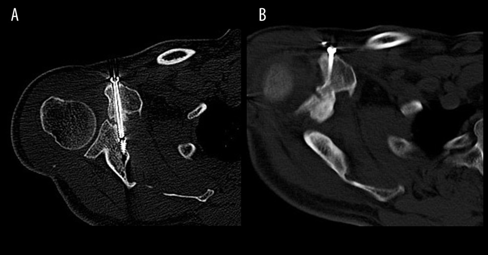 CT scan coracoid process fracture. (A) Delayed union was noted at 5 months, and (B) the fracture healed at 8 months.