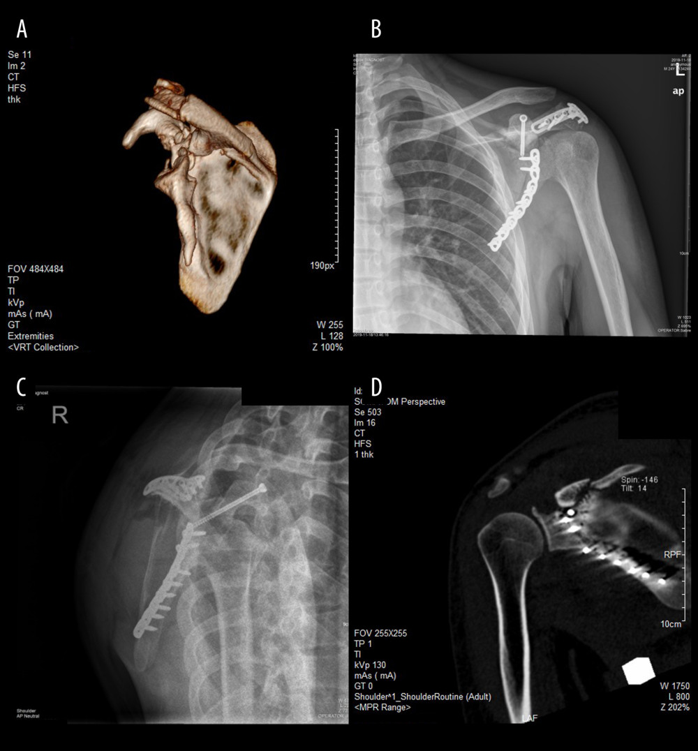 Case 1, coracoid process fracture with Eyres type V associated with Miller type III and Ideberg type IV. (A) 3D reconstruction of a CT scan. (B, C) Postoperative X-ray showing screw fixation of the coracoid process and plate fixation of the scapular neck, scapular body and acromion. CT scan with coronal (D), and anterior views showing the tip of the screw.
