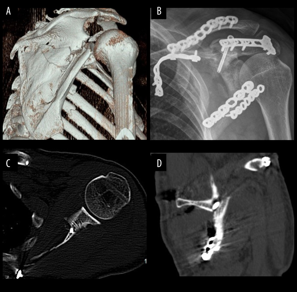 Case 2, coracoid process fracture with Eyres type V associated with Miller type III and Ideberg type V. (A) 3D reconstruction of a CT scan. (B) Postoperative X-ray showing screw fixation of the coracoid process and plate fixation of the scapular neck, scapular body, acromion, and clavicle. CT scan with axial (C), and sagittal (D) views showing the tip of the screw.