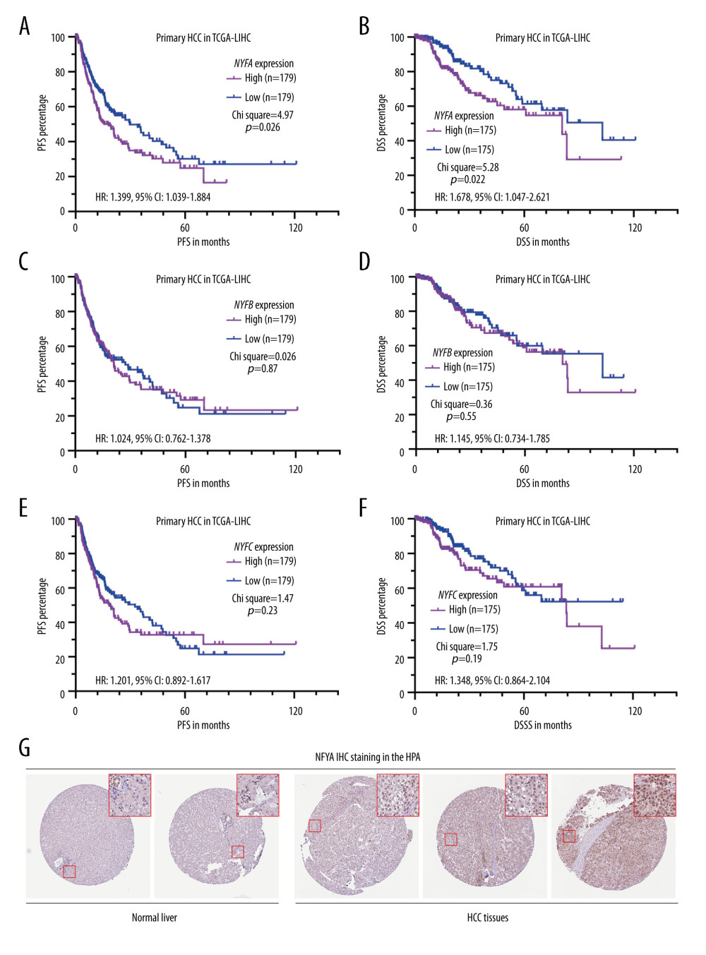 HCC patients with elevated NFYA expression had significantly worse survival(A–F) K-M analysis for DSS (B, D, F) and PFS (A, C, E) comparison was performed. Patients with primary HCC in TCGA were classified into 2 groups by the median NFYA (A, B), NFYB (C, D) or NFYC (E, F) expression. (G) NFYA protein expression in normal liver and HCC tissues. IHC staining images were obtained from the HPA, from the following links: https://www.proteinatlas.org/ENSG00000001167-NFYA/tissue/liver and https://www.proteinatlas.org/ENSG00000001167-NFYA/pathology/liver+cancer#ihc.