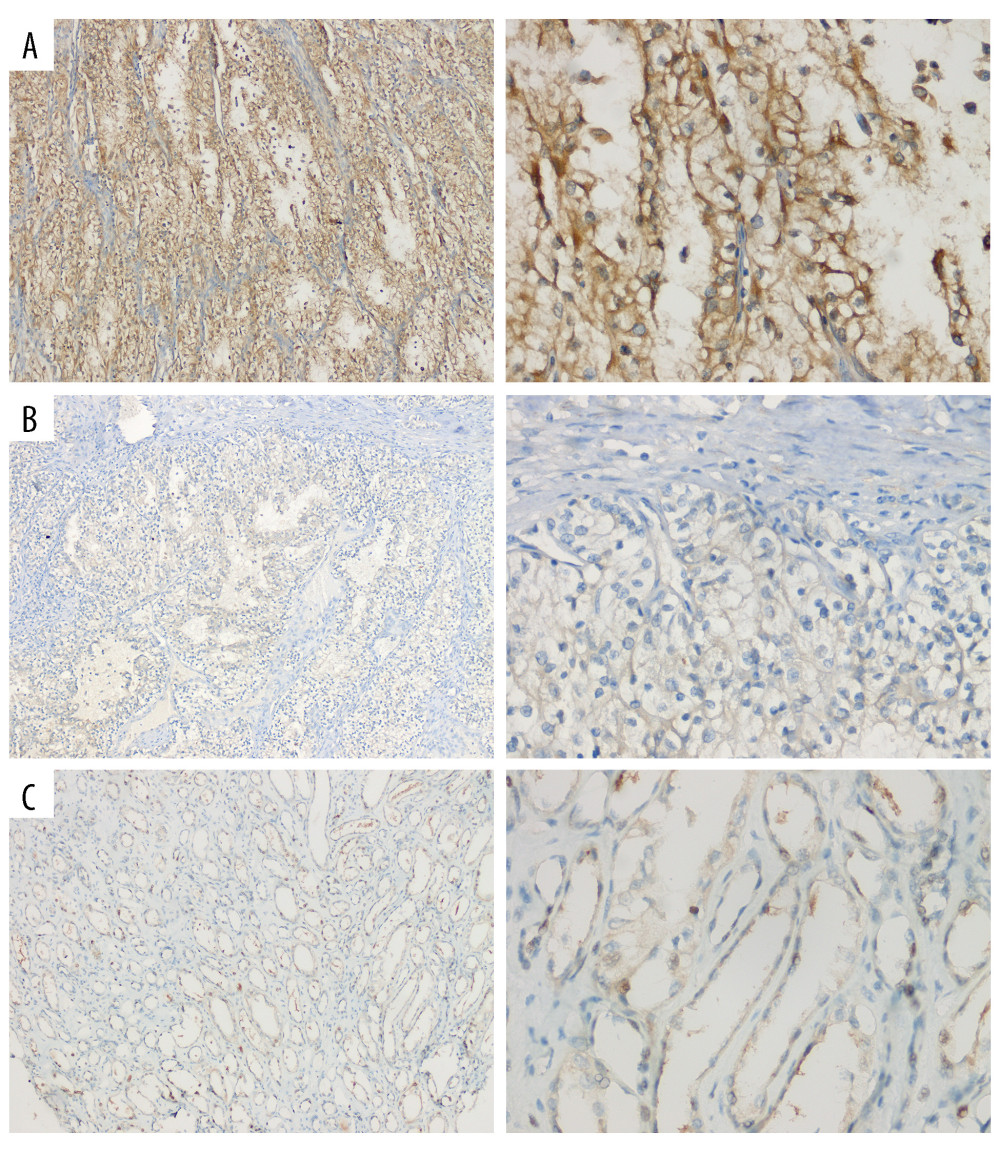 Representative HE staining and immunostaining images of SPATA18. (A) Strong SPATA18 expressed in the tumor tissues of ccRCC patients. (B) Weak SPATA18 expressed in the tumor tissues of ccRCC patients. (C) SPATA18 expressed in the adjacent tissues of ccRCC patients. The pictures were microphotographed (Leica, Germany) and processed using WPS Office (version 11.1.0.12132). Left side is 100 magnification and right side is 400 magnification.