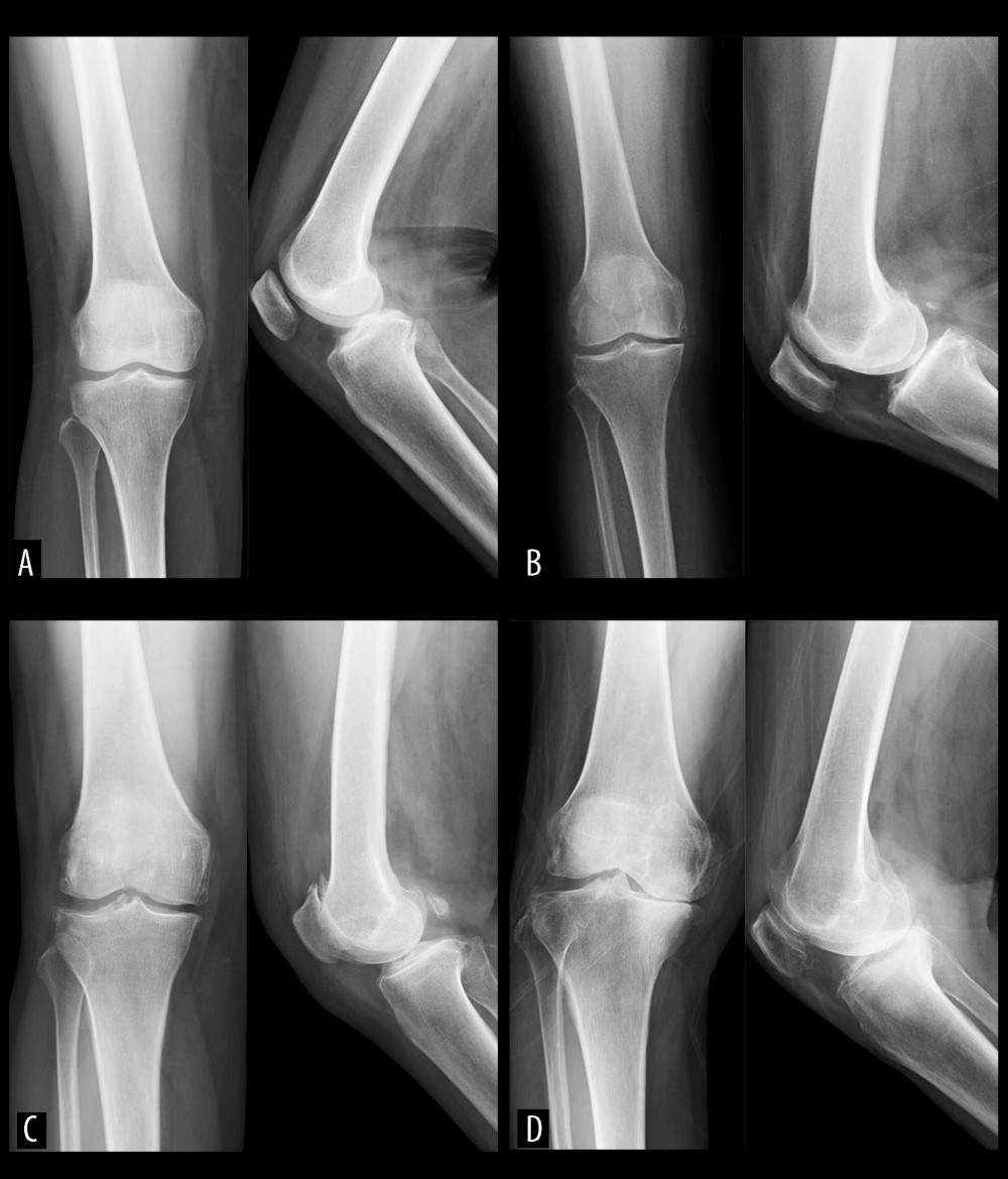 Upright position X-ray of patients with different Kellgren-Lawrence grades of knee osteoarthrosis.(A) Grade I, slight narrowing of knee joint space with suspicious osteophyte formation, and the patient was defined as early-stage; (B) Grade II, moderate narrowing of knee joint space with small osteophyte formation, and the patient was defined as mid-stage; (C) Grade III, obvious narrowing of knee joint space with moderate osteophyte formation, and the patient was defined as mid-stage; (D) Grade IV, severe narrowing of the knee joint space and massive osteophyte formation, and the patient was defined as end-stage.