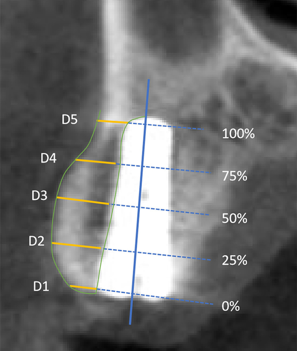 CBCT illustrating of labial alveolar bone thickness. (Microsoft PowerPoint 2003).