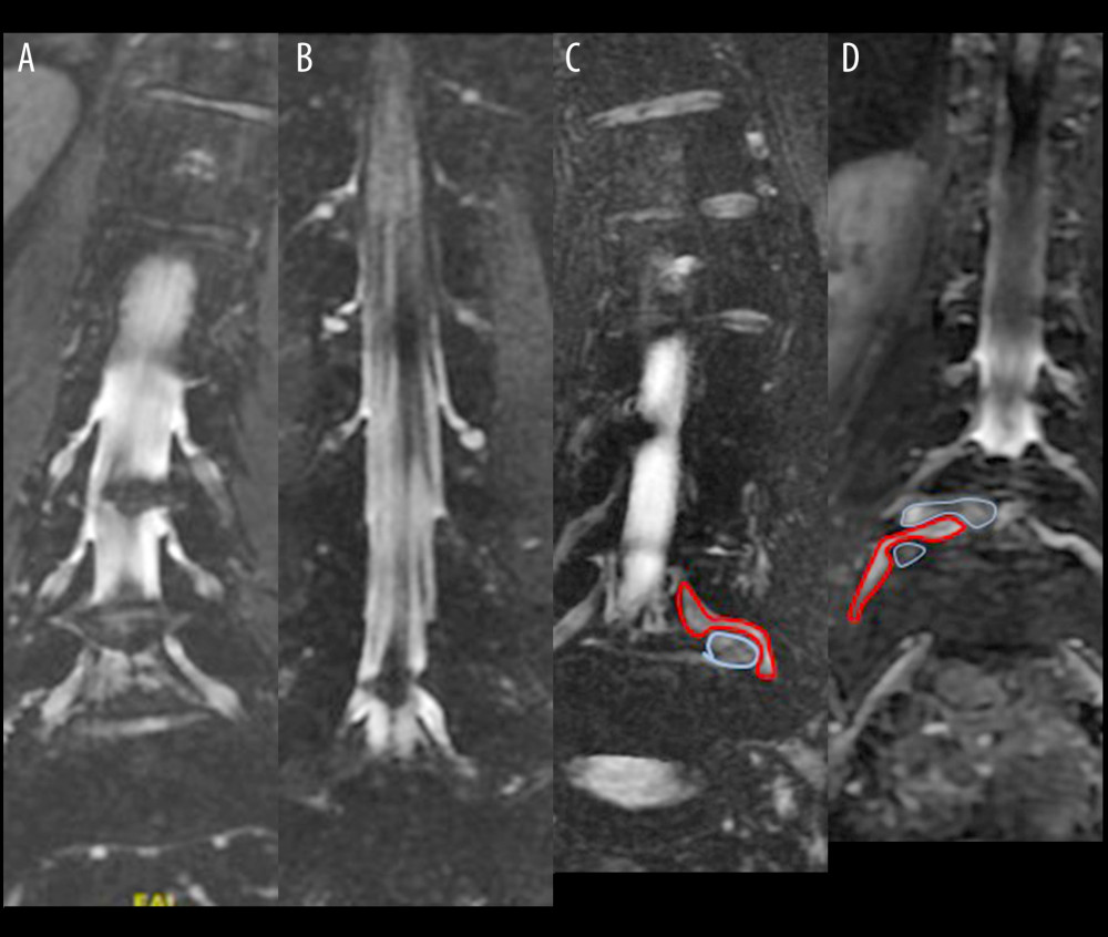 (A) The exit of the L4 nerve root is clear and obvious, and the herniated disc above does not compress the nerve root. In c2, (B) the exit of the L5 nerve root is just at the plane of the herniated disc, showing ganglion enhancement and nerve root interruption. (C) The herniated disc pushes against the ganglion. (D) The L5 nerve root is simultaneously compressed by the upper disc and pushed by the lower disc. MRI – magnetic resonance imaging; CMRI – coronal magnetic resonance imaging of three-dimensional fast-field echo with water-selective excitation.