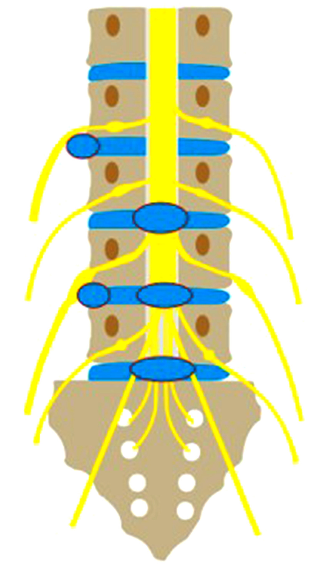 The relationship between the lumbosacral nerve and intervertebral disc herniation.