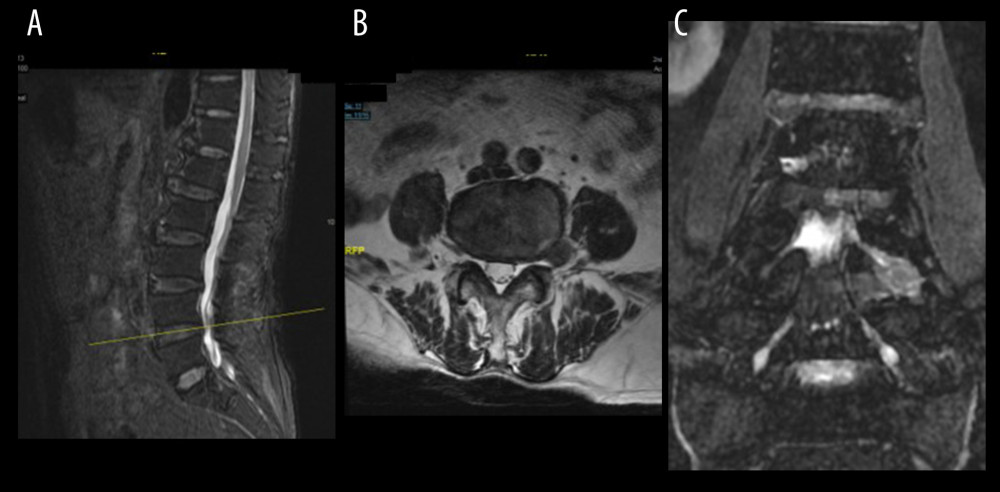 (A) Sagittal MRI localization, (B) Axial t2-weighted image shows good foraminal space, large herniated disc lateral to the foramina (red arrow), (C) CMRI clearly shows herniated disc (red arrow) pushing the squeezed nerve root (yellow arrow) is deformed, and the hyperintensity changes. MRI – magnetic resonance imaging; CMRI – coronal magnetic resonance imaging of three-dimensional fast-field echo with water-selective excitation.