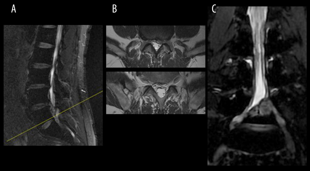 (A) Sagittal MRI localization, a circular low-density shadow can be seen at the posterior edge of the L5 vertebral body, (B) T2-weighted scan shows the b1 axial plane (yellow arrow) of the next scan image b2 axial plane (yellow arrow), just avoiding the circular low signal (red arrow), (C) CMRI clearly shows that the huge herniated intervertebral disc (red arrow) squeezes the nerve root. MRI, magnetic resonance imaging; CMRI, coronal magnetic resonance imaging of three-dimensional fast-field echo with water-selective excitation.