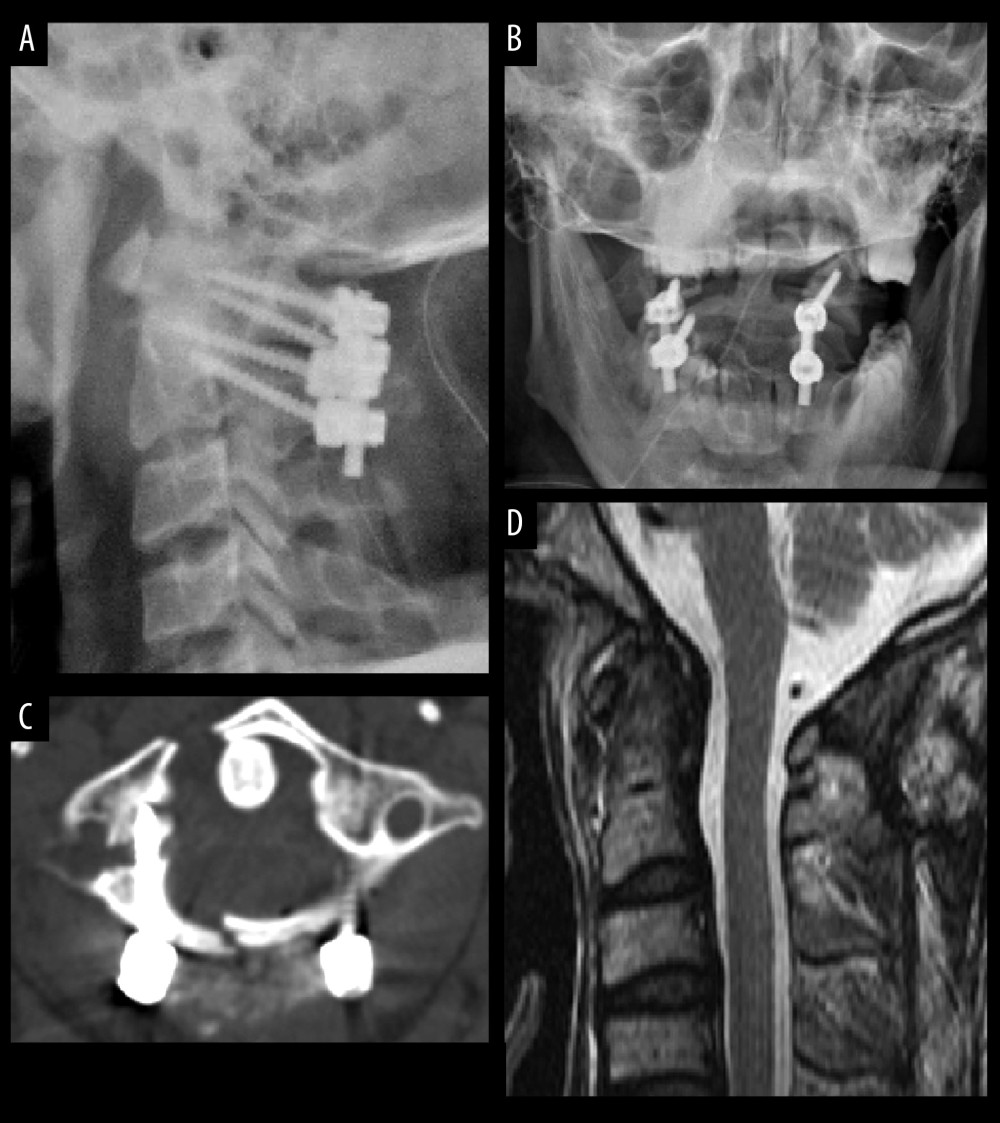 The same patient underwent posterior C1–C2 screw-rod fixation and fusion. (A, B) Postoperative cervical lateral and mouth-open X-rays revealed optimal sequence and position of internal fixation. (C) CT scan revealed correct placement of pedicle screws. (D) Postoperative MRI showed no damage to the spinal cord.