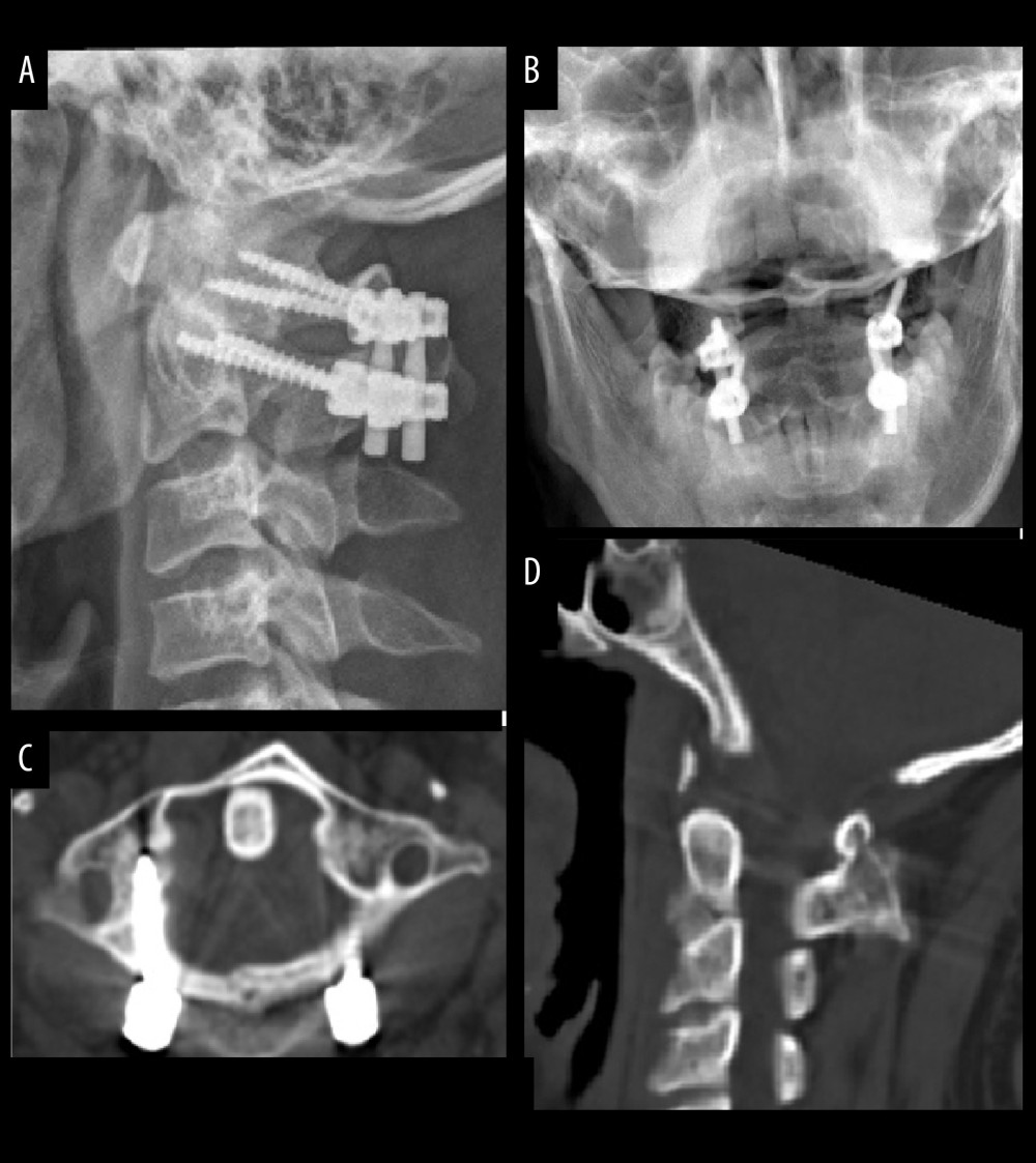 The same patient was followed up 6 months after surgery. (A, B) Cervical lateral and mouth-open X-rays revealed stable fixation and stability of C1–C2. (C, D) CT scans indicated stable location of pedicle screws and solid bone fusion.