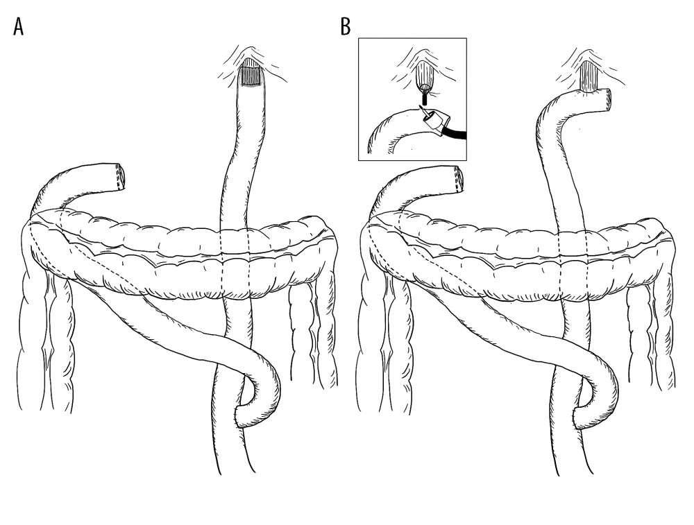 Schematic presentation of gastrointestinal tract reconstruction after total gastrectomy end-to-end hand-sewn esophagojejunostomy (A), end-to-side circular stapled esophagojejunostomy (B). The figure was created by author Karolina Majewska using GoodNotes 5 application, Time Base Technology Limited, © 2011–2022 GoodNotes Limited.