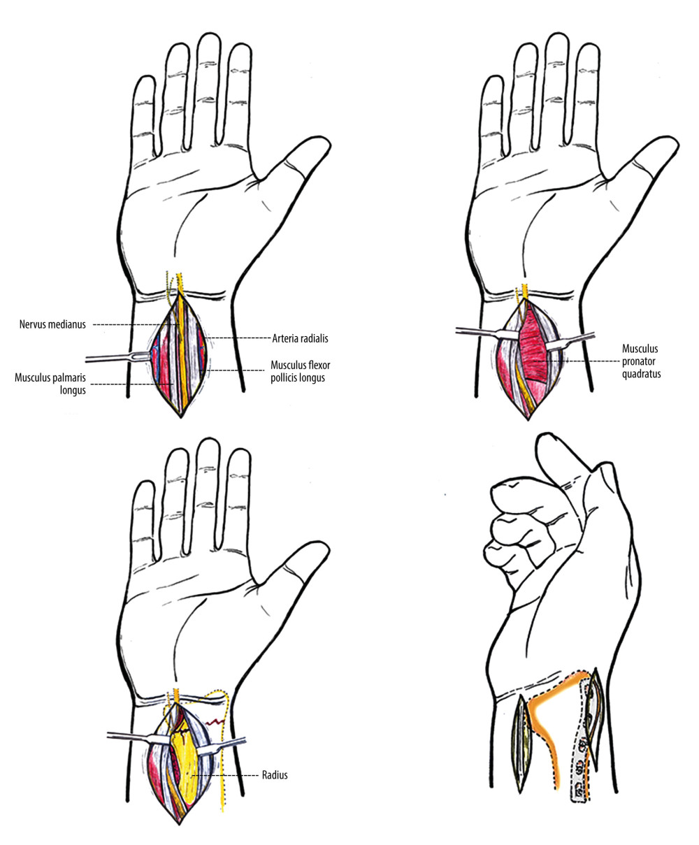 Diagram for distal radius fracture surgery. The medial approach and radial auxiliary approach were used.