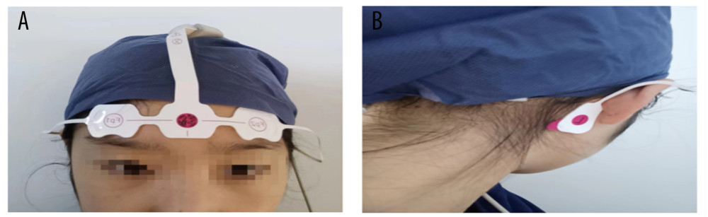(A, B) Placement of electroencephalogram (EEG) electrodes. The EEG electrodes are placed on the forehead (FPZ), 1 to 2 cm above the bilateral eyebrows (left FP1, right FP2) and on the bilateral mastoid (left C1, right C2).