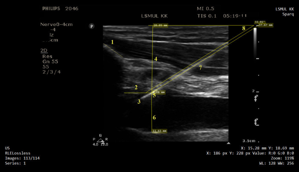 Ultrasound image of infraclavicular area, guidewire, subclavian and axillary veins are displayed in longitudinal view: 1 – clavicular bone; 2 – distance from the clavicle bone shadow and vein penetration point; 3 – guidewire placed in the vein lumen; 4 – vein depth; 5 – vein penetration point; 6 – vein diameter; 7 – intratissue passage; 8 – puncture angle.