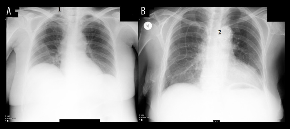 Catheter tip confirmation, chest X-ray obtained after catheterization. (A) Image 1, showing catheter’s tip is located in right jugular vein. (B) Image 2, showing catheter’s tip is located in a left brachiocephalic vein.