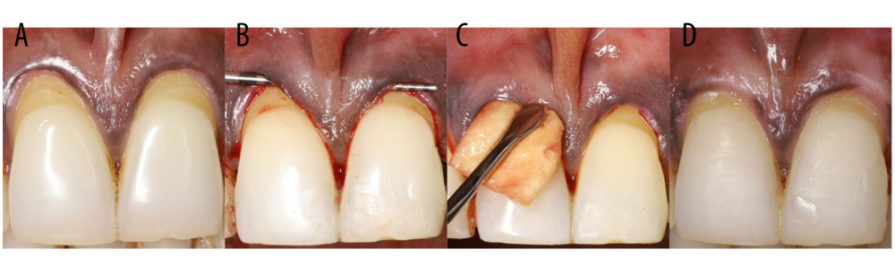 Root coverage procedure with chorion membrane. (A) Baseline, (B) Tunnel access, (C) Insertion of chorion membrane, (D) Post-operative 6 months.