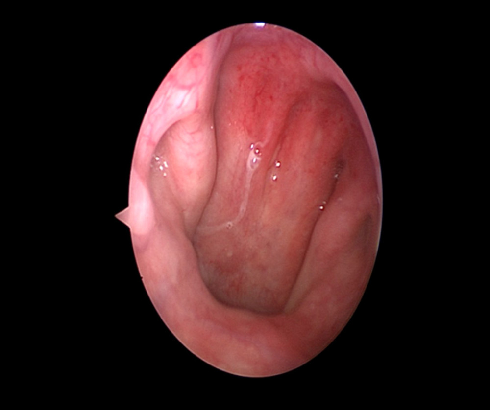 Nasal endoscopy of the right pharyngeal mucosa showing mild edema, and no new organisms in the nasopharynx.