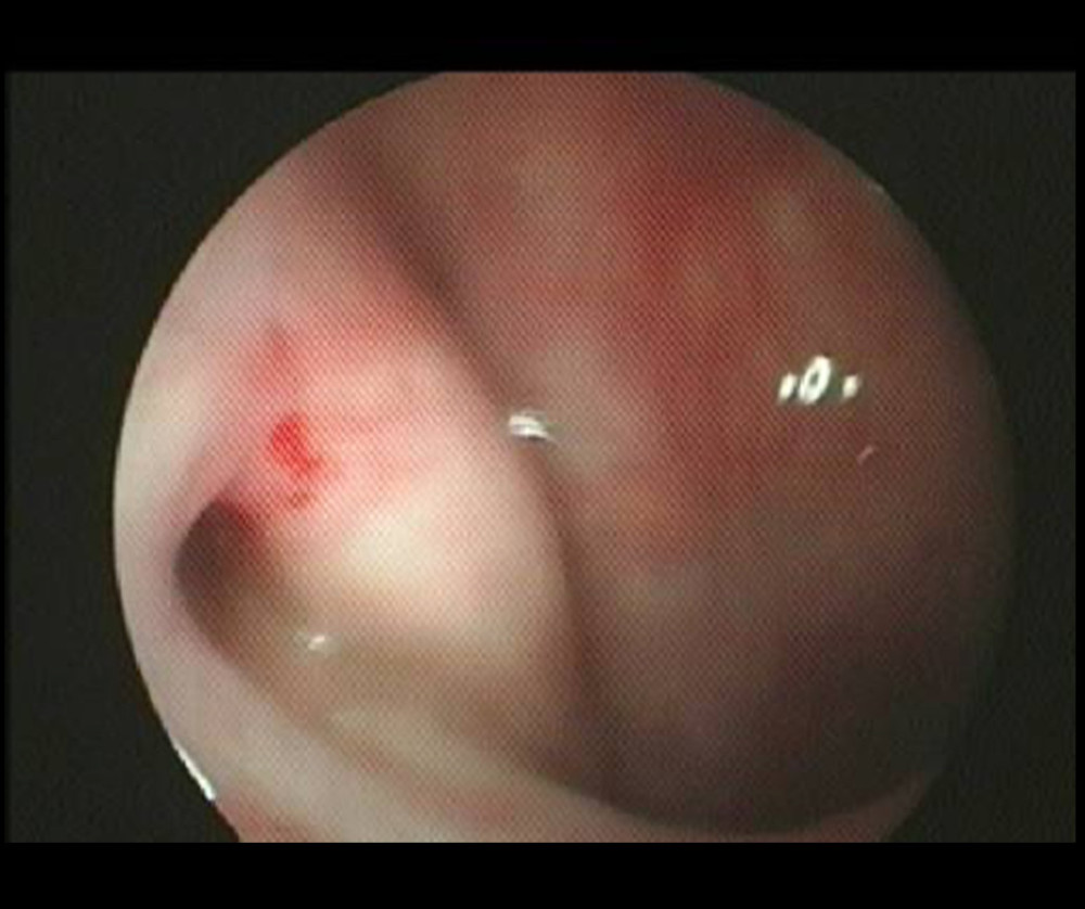 Enlarged pharyngeal ostium of the right eustachian tube and smooth and undamaged mucous membranes after BET.