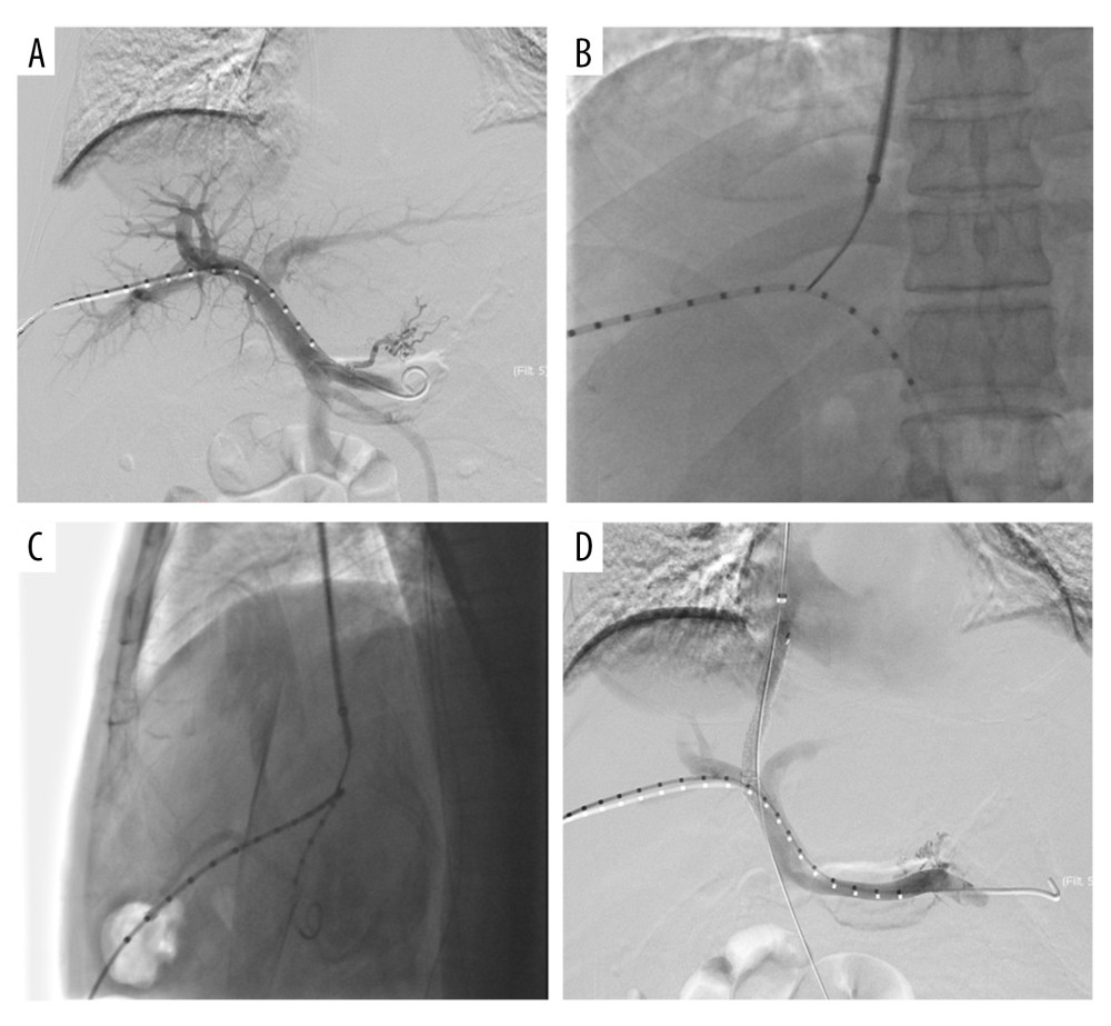 Double C-arm digital subtraction angiography (DSA) guidance for portal vein (PV) puncture. (A) Angiography via a marked pigtail catheter placed in the PV to assess the puncture site. (B, C) The front and side PV positions are compared in detail using double C-arm DSA, and the most appropriate puncture point is determined. (D) After transjugular intrahepatic portosystemic shunt placement, angiography reveals that the left and right branches of the PV and shunt channels are unobstructed. Image Software: Adobe Photoshop, CS6, Adobe Systems.