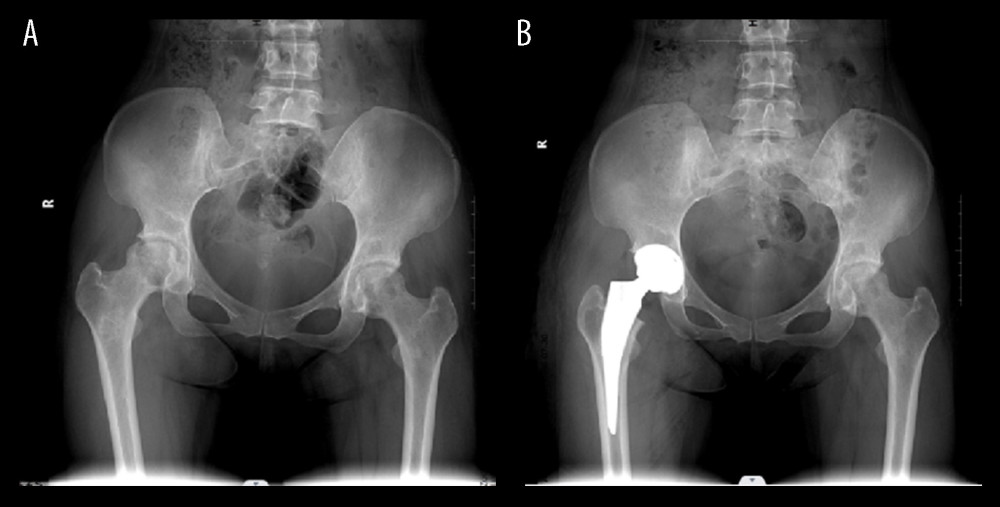 (A) Anteroposterior projection of preoperative X-ray of Association Research Circulation Osseous (ARCO) stage III patient shows collapsed femoral head with normal joint space. (B) Anteroposterior projection of postoperative X-ray of ARCO stage III patient shows well-positioned hip joint prosthesis.