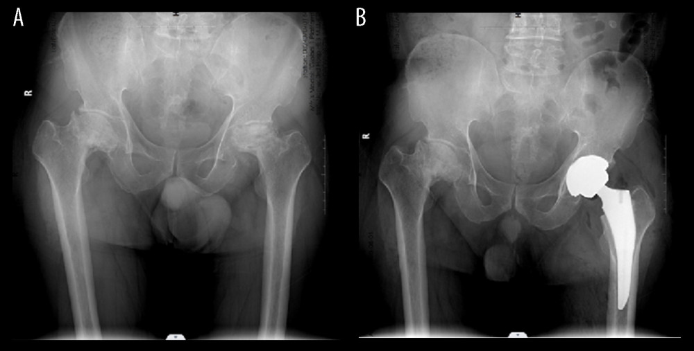 (A) Anteroposterior projection of preoperative X-ray of Association Research Circulation Osseous (ARCO) stage IV patient shows the absence of joint space and severe periacetabular hyperplasia. (B) Anteroposterior projection of postoperative X-ray of ARCO stage IV patient shows well-positioned hip joint prosthesis.