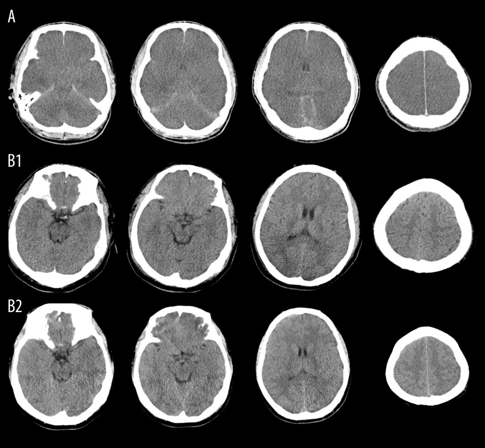 Representative Images of brain CT scanBrain computed tomography (CT) scan of a 22-year-old male heatstroke patient admitted with persistent coma showed diffuse encephalic swelling, compressed or occluded ventricles, sulci, and cisterna, and extensive subarachnoid hemorrhage on the 3rd day after admission (A). Another 27-year-old male heatstroke patient admitted with GCS of 5 survived; although his brain CT scan did not show swelling or edema at admission (B1), and a light encephalic swelling was shown by a CT scan 6 days later (B2), his GCS improved after admission and he survived.