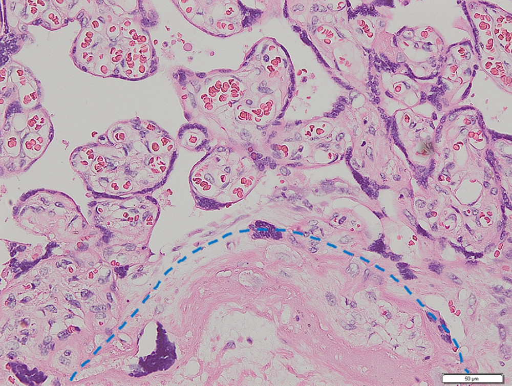 Placenta non-accreta. Area of chorionic villi covered by syncytiotrophoblast and cytotrophoblast is shown above the dashed line, while the myometrial area is shown below the dashed line (hematoxylin and eosin staining, magnification ×200).