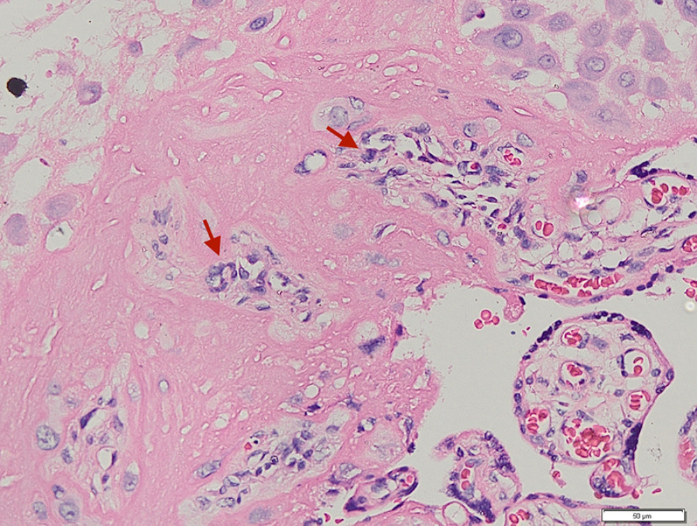 Placenta accreta. Groups of intermediate trophoblastic cells invaded the myometrium (arrows), and the villi are located outside and inside the myometrium (hematoxylin and eosin staining, magnification ×200).