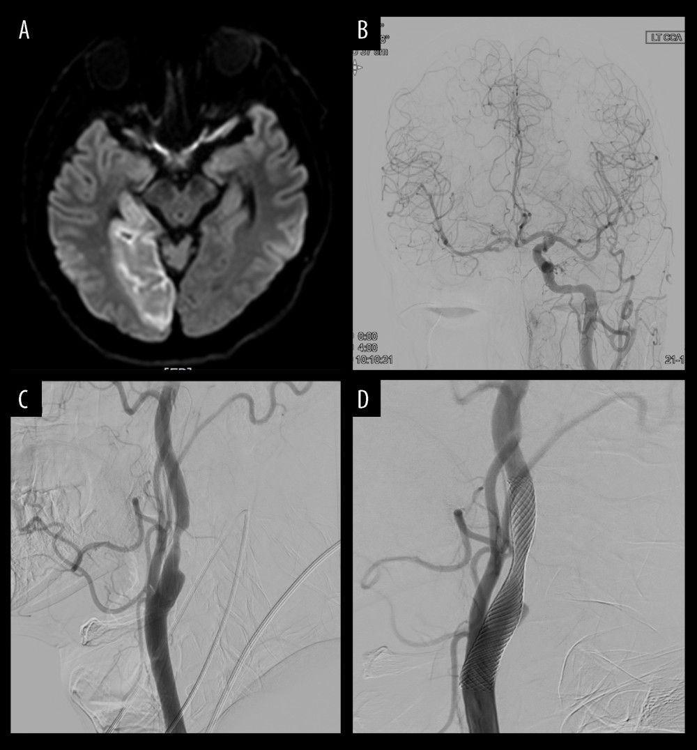 Illustration of case 1(A) Magnetic resonance imaging reveals an acute right posterior cerebral artery (PCA) territory infarction. (B) Angiography reveals chronic occlusion of the right intracerebral artery (ICA), and the left ICA flow was considered to supply to the right anterior cerebral artery, middle cerebral artery, and PCA through the anterior communicating artery. (C) Degree of left carotid stenosis is 80% on angiography. (D) Carotid artery stenting (9×50 mm) is performed for left carotid stenosis.