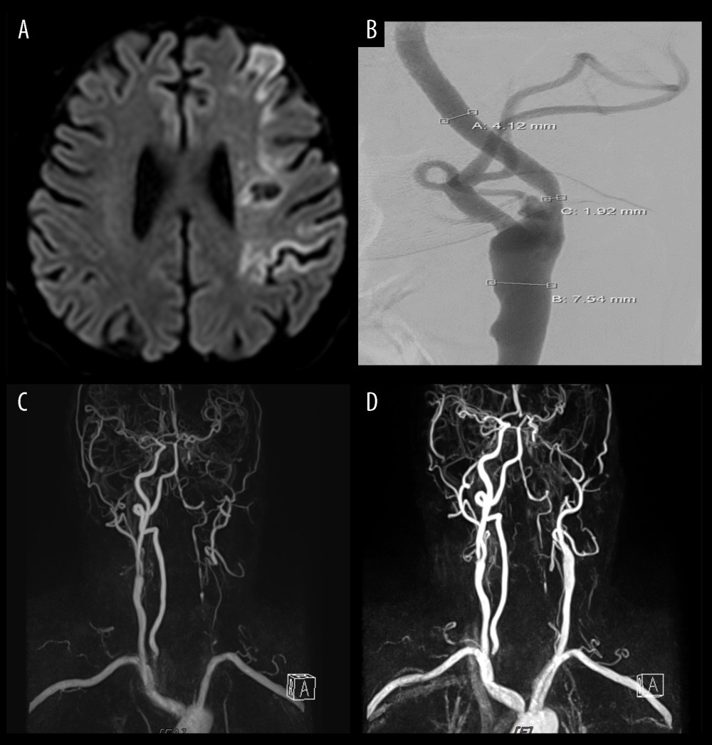 Illustration of case 2(A) Magnetic resonance image reveals recurrent left middle cerebral artery territory infarction. (B) Degree of left carotid stenosis is 55% on angiography, which has slightly increased from 50%. (C) Magnetic resonance angiography shows left common carotid artery occlusion following carotid endarterectomy. (D) Magnetic resonance angiography shows left intracerebral artery occlusion following emergent thrombus removal.