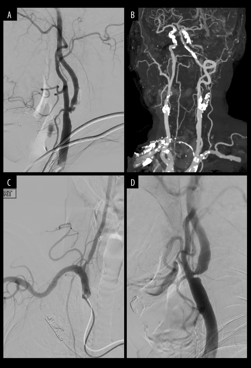 Cases of selecting carotid endarterectomy(A) Plaque ulcerative change. (B) Heavily, extensive calcified plaque. (C) Aortic arch type II (or III). (D) Acute entry of angle.