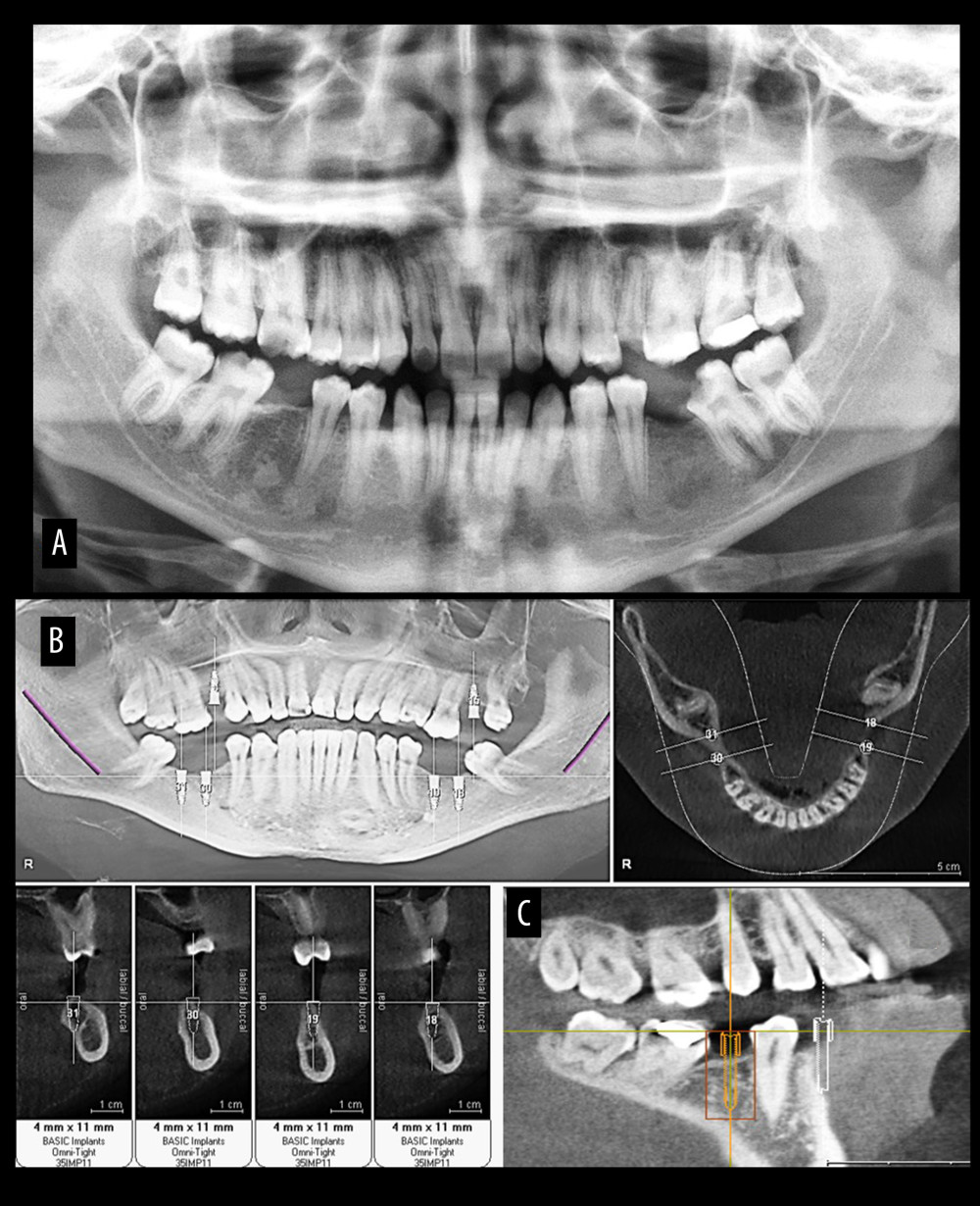 Diagnostic evaluation for implant selection using conventional digital orthopantomograph (A) and cone beam computed tomography (CBCT) (B) and (C). Figure created using MS PowerPoint, version 20H2 (OS build 19042,1466), Windows 11 Pro, Microsoft corporation).