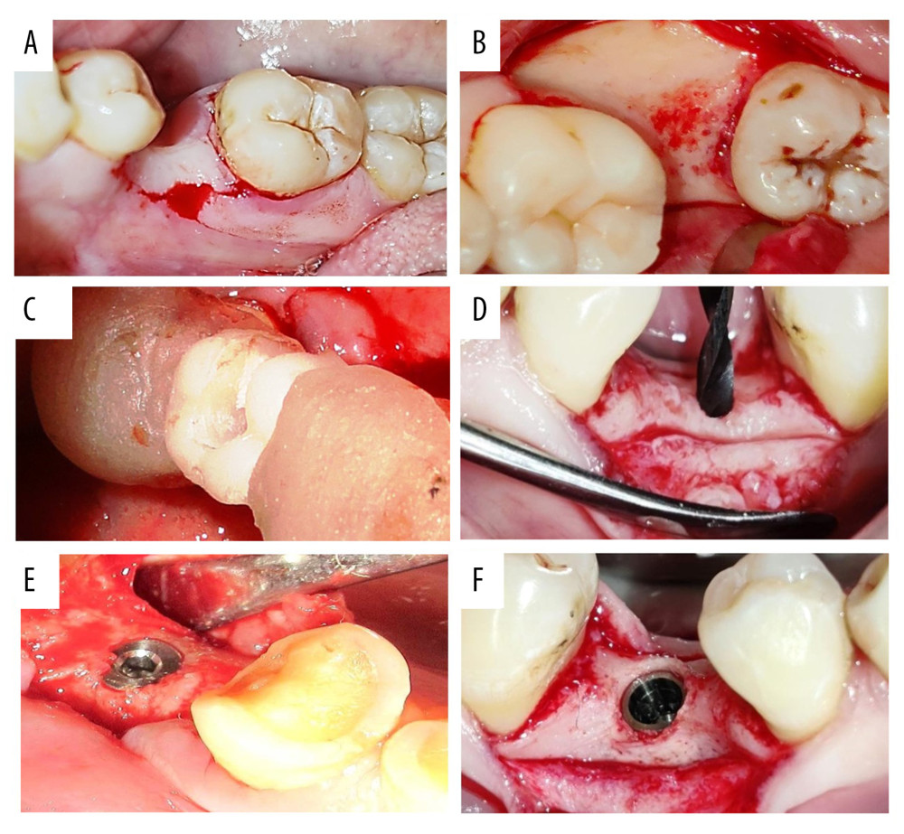 Sequence of implant placement showing crestal incision (A), flap reflection (B), surgical guide placement (C), pilot drilling (D), equicrestal implant fixture placement (E), and Subcrestal implant placement (F). Photographs taken using a digital single-lens reflex (DSLR) (Canon EOS 700D) with 100 mm macro lens) with/without ring flash. Compiled figure created using MS PowerPoint, version 20H2 (OS build 19042,1466), Windows 11 Pro, Microsoft corporation).
