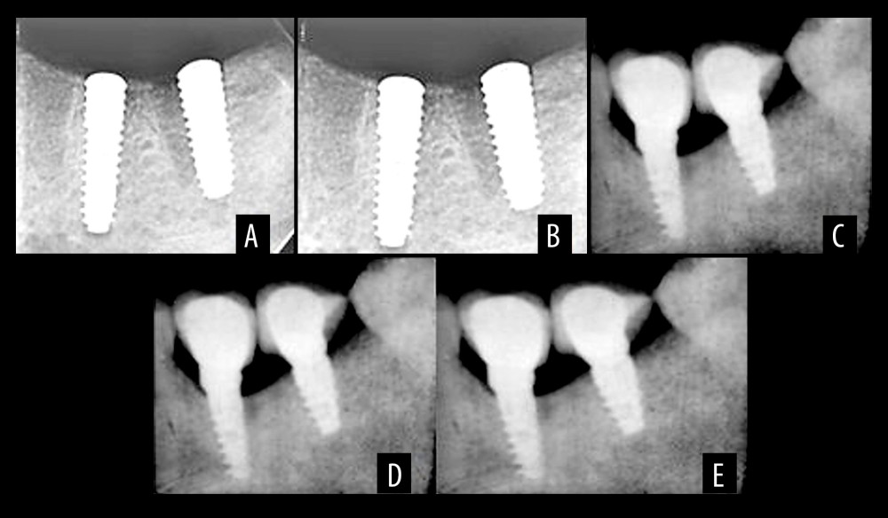 Radiographic interpretation of equicrestal implant placement (A) At the time of placement (B) At 3 months (C) At 6 months (D) At 9 months (E) At 12 months. Figure created using MS PowerPoint, version 20H2 (OS build 19042,1466), Windows 11 Pro, Microsoft corporation).