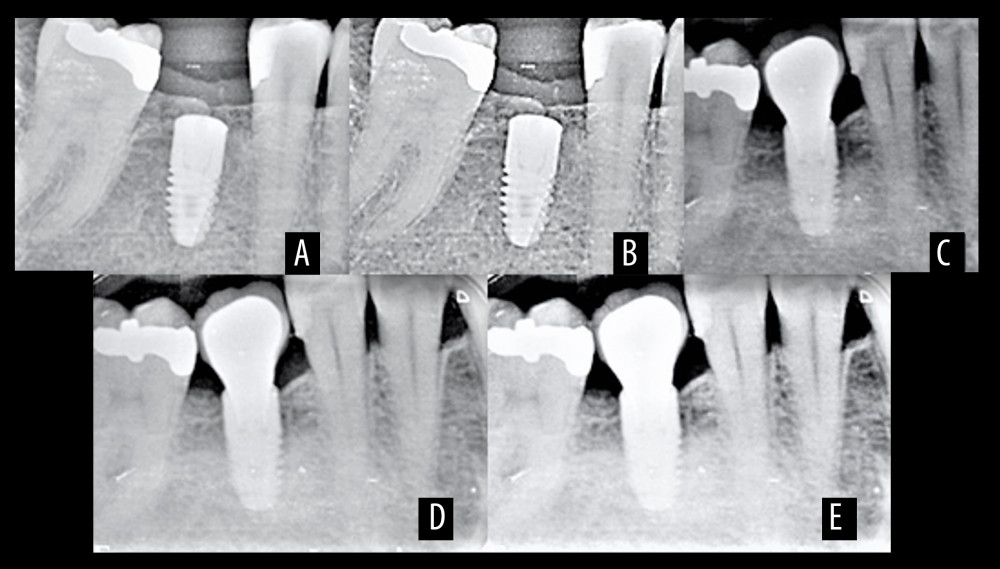 Radiographic interpretation of subcrestal implant placement (A) At the time of placement (B) At 3 months (C) At 6 months (D) At 9 months (E), At 12 months. Figure created using MS PowerPoint, version 20H2 (OS build 19042,1466), Windows 11 Pro, Microsoft corporation).