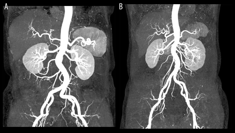 Comparison of MIP using conventional CT scanning at 120 kVp and BMI-adapted individualized kVp at 70 kVp. (A) Image of a 65-year-old female patient with BMI of 20.5 kg/m2 using 70 kVp tube voltage and 300 mgI/kg contrast dose. (B) Image of a 50-year-old female patient with BMI of 20.3 kg/m2 using 120 kVp tube voltage and 500 mgI/kg contrast dose. All images had 5 points in diagnostic confidence score.