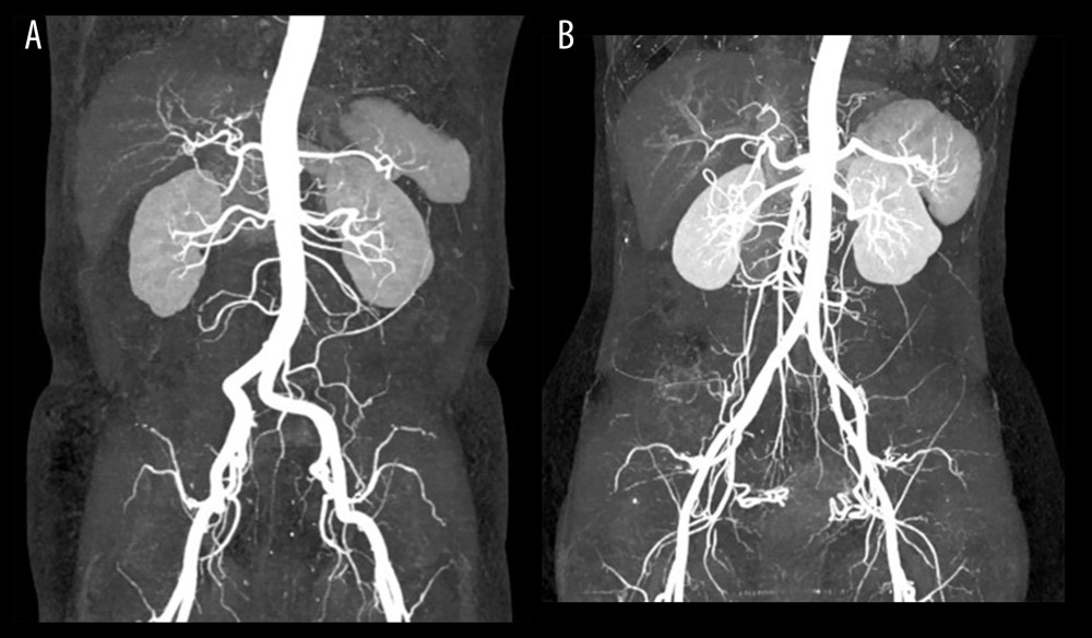 Comparison of MIP using conventional CT scanning group at 120 kVp and BMI-adapted individualized group at 80 kVp. (A) Image of a 62-year-old male patient with BMI of 22.8 kg/m2 using 80 kVp tube voltage and 300 mgI/kg contrast dose. (B) Image of a 67-year-old male patient with BMI of 23.0 kg/m2 using 120 kVp tube voltage and 500 mgI/kg contrast dose. The 80 kVp CT reduced the radiation dose in abdominal CTA while showing comparable or superior image quality.