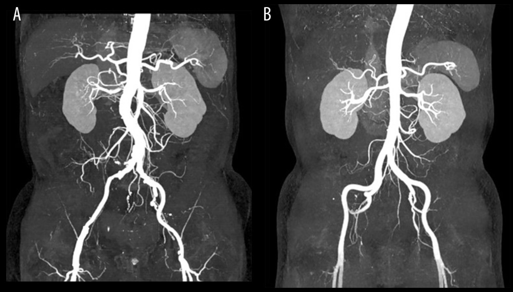 Comparison of MIP using conventional CT scanning group at 120 kVp and BMI-adapted individualized group at 100 kVp. (A) Image of a 62-year-old male patient with BMI of 25.1 kg/m2 using 100 kVp tube voltage and 300 mgI/kg contrast dose. (B) Image of a 53-year-old male patient with BMI of 24.9 kg/m2 using 120 kVp tube voltage and 500 mgI/kg contrast dose.