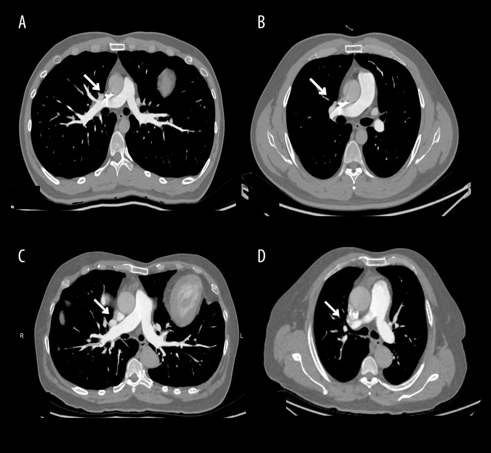 Computed tomography pulmonary angiography scans were obtained with standard protocol (A, B) and individualized protocol (C, D). In both images a and b, the superior vena cava showed obvious beam-hardening artifacts.