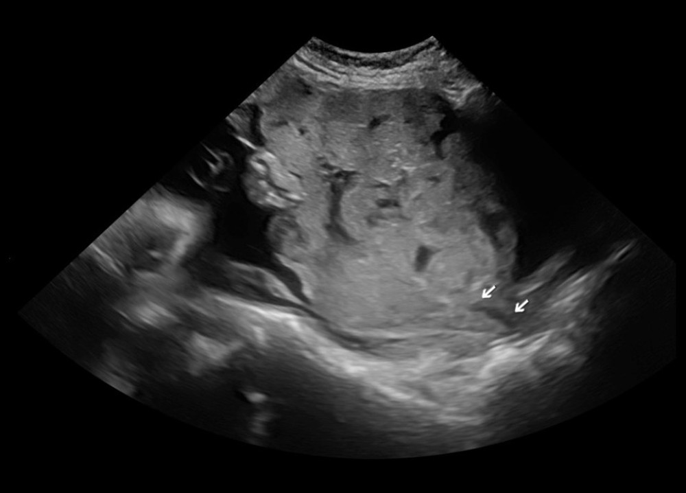 Anterior placenta. The white arrows indicate the cervix, and the red arrow indicates the bladder.