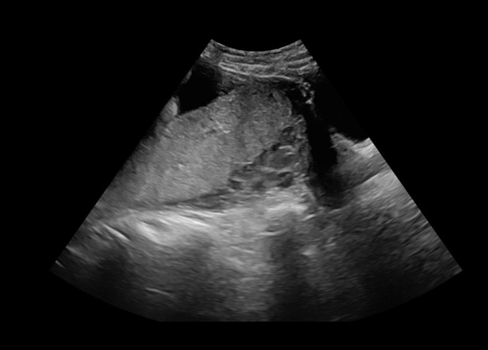 Posterior placenta. The red arrow indicates the bladder, and the blue arrow indicates the cervix.